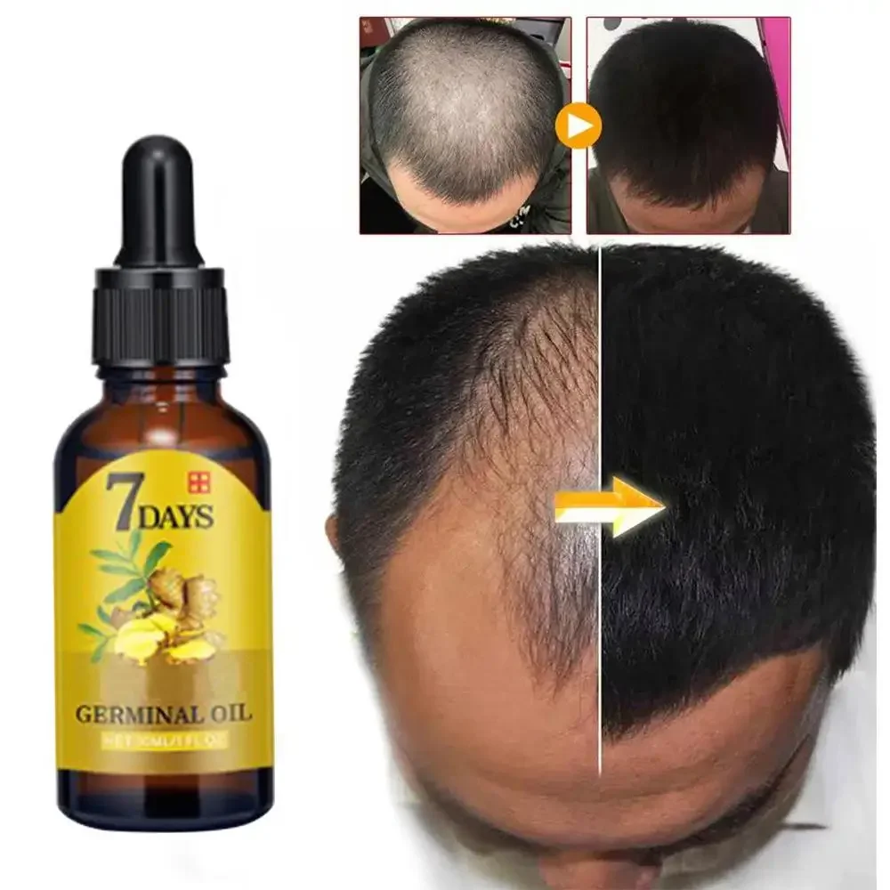 Beard Oil Growth - 育毛ジンジャー高速成長髪エッセンシャルオイルヘアケア損失防止オイル頭皮トリートメント男性女性ダメージヘア